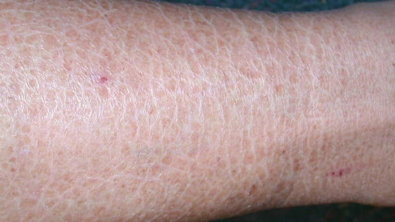 Skin Disorders